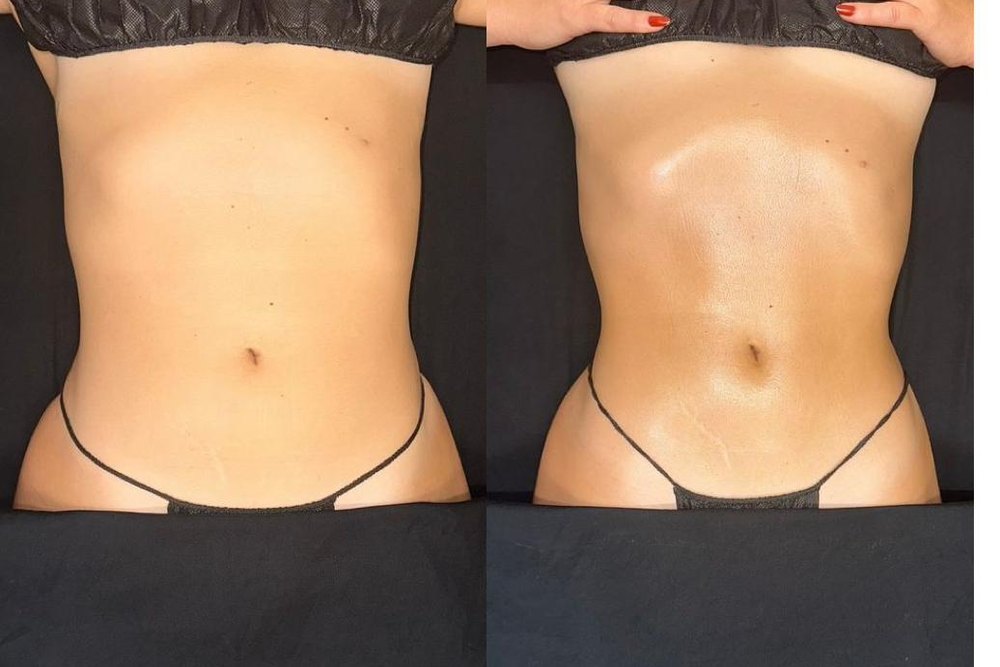 Avant et après sur l'abdomen, après une série de séances de drainage