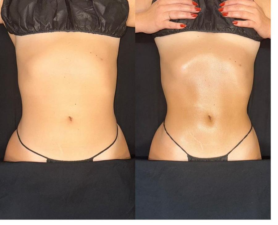 Avant et après — abdomen